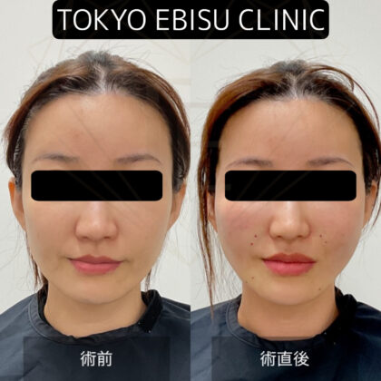 中顔面糸リフト