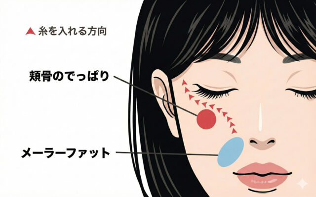 中顔面糸リフト解説