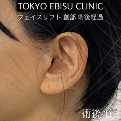 フェイスリフト 創部術後経過
