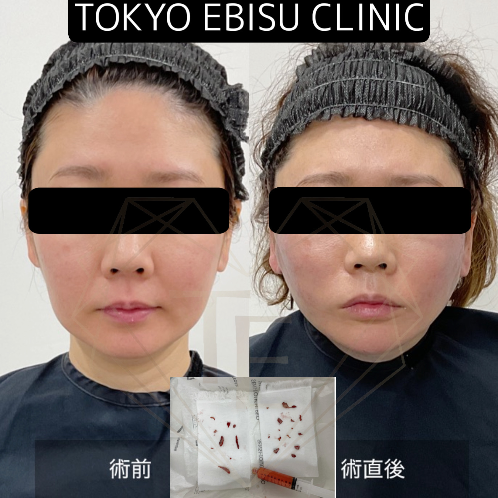 フェイスリフト症例　40代女性